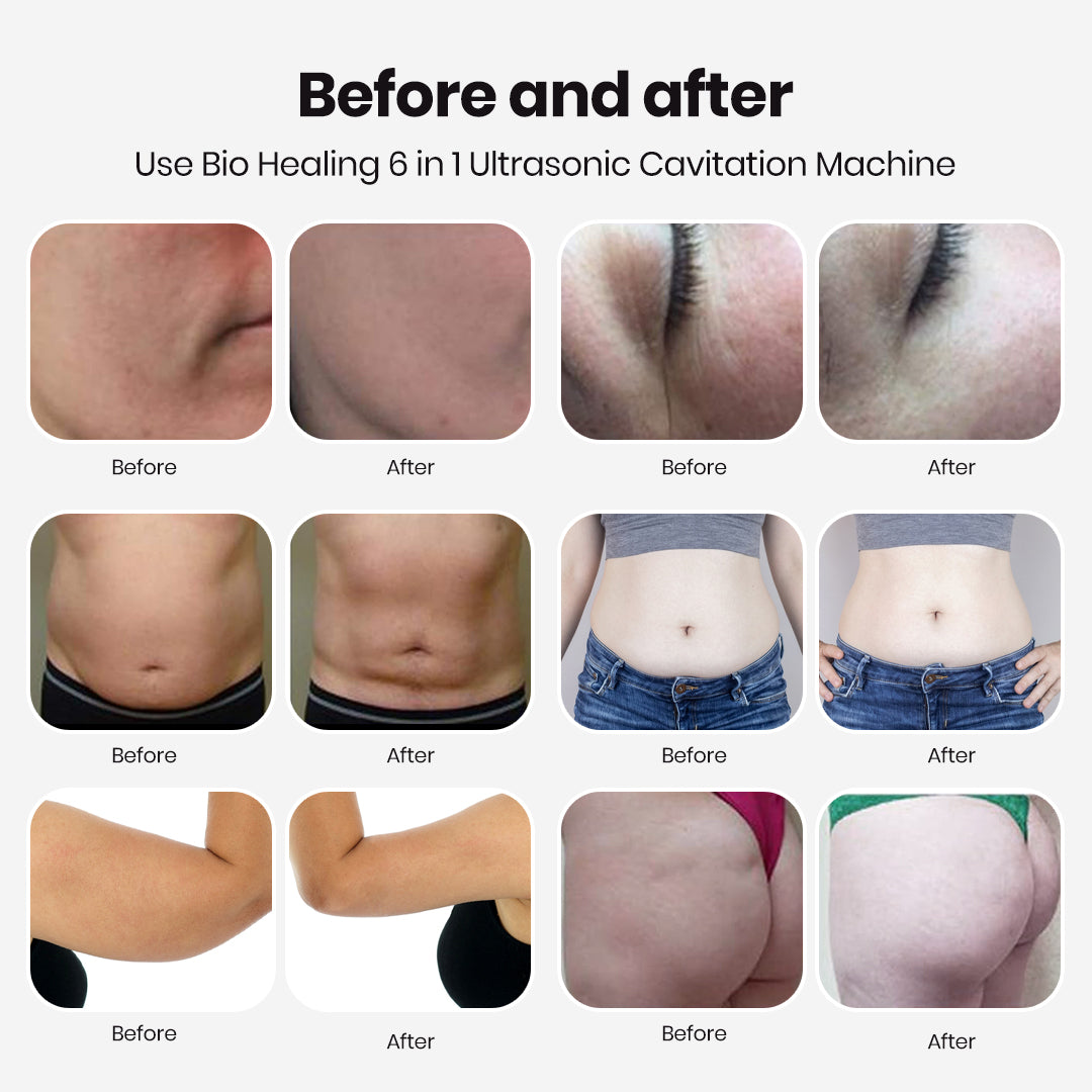 Bio Healing 6-in-1 Ultrasonic Cavitation + RF Machine